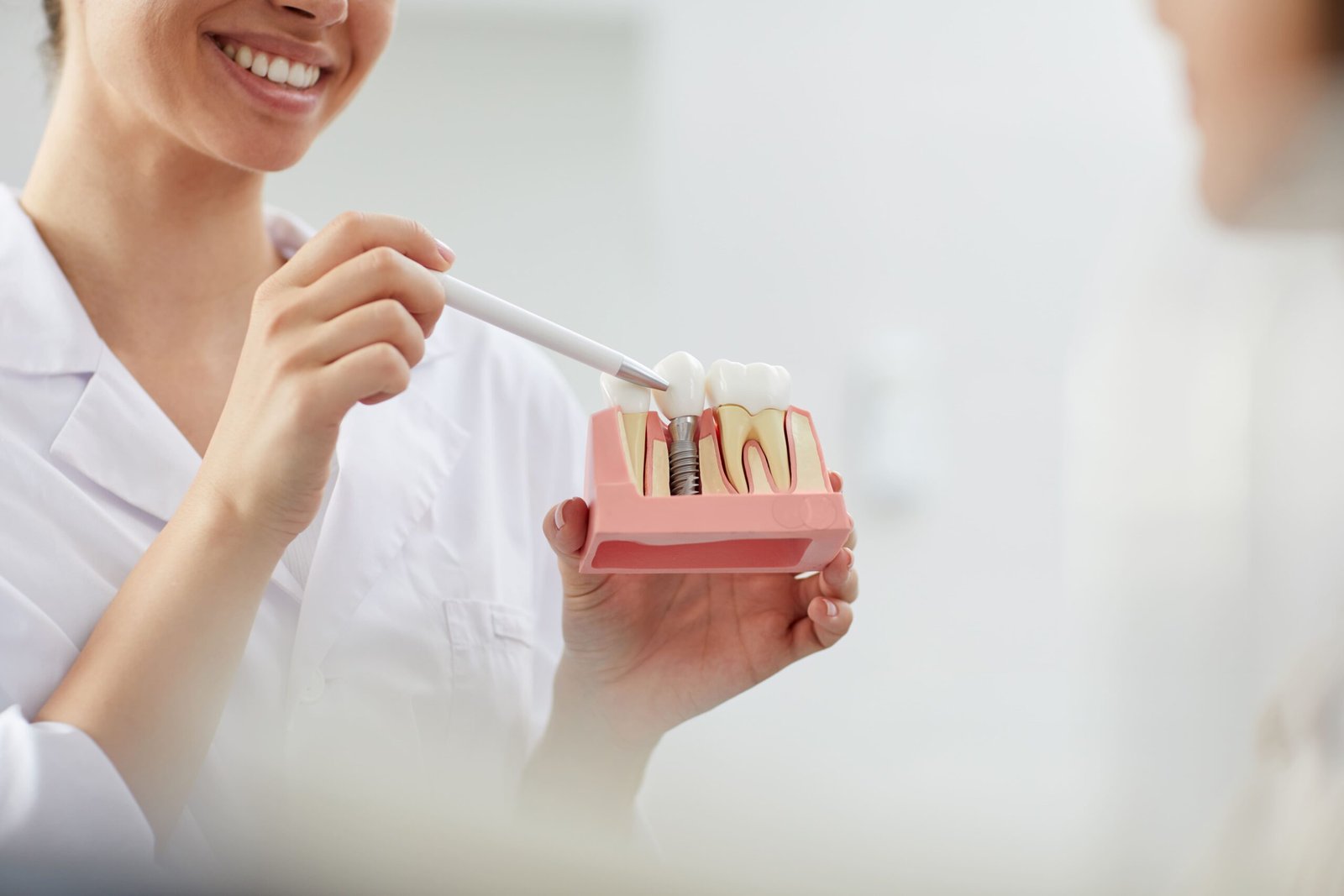 Implantes Dentários